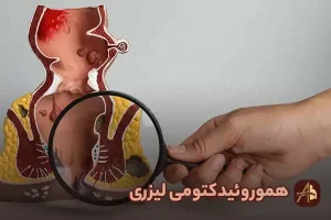 لیزر هموروئید