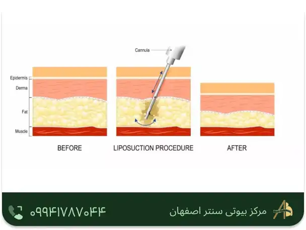 جراحی لیپوساکشن
