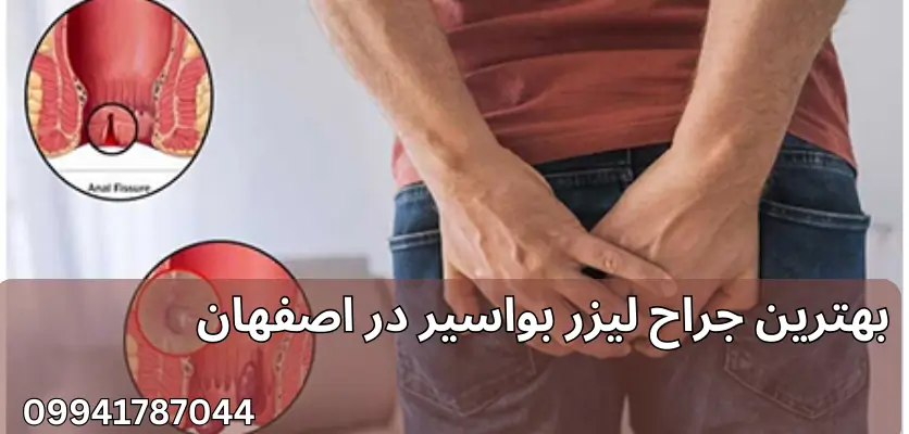 متخصص لیزر همورئید در اصفهان