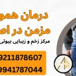 درمان هموروئید مزمن در اصفهان