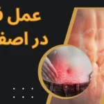 5 نکته مهم درباره علائم فتق و درمان آن
