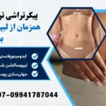استفاده همزمان از لیپوساکشن و لیفت بدن