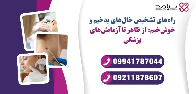 تفاوت خال خوش خیم و بدخیم