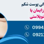 افتادگی پوست شکم بعد از زایمان