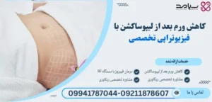 کاهش ورم بعد از لیپوساکشن