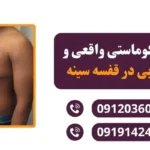 تفاوت ژنیکوماستی واقعی و تجمع چربی در قفسه سینه