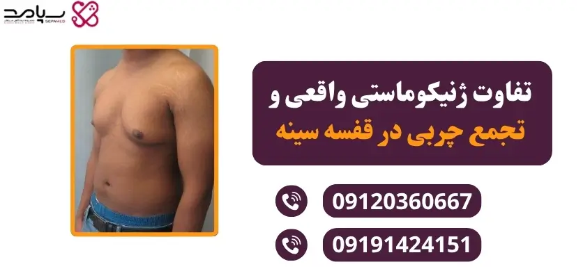 تفاوت ژنیکوماستی واقعی و تجمع چربی در قفسه سینه
