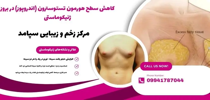 کاهش سطح هورمون تستوسترون (اندروپوز) در بروز ژنیکوماستی