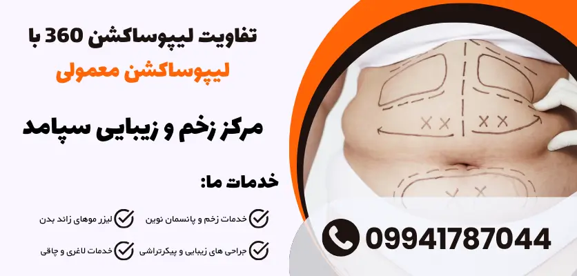تفاوت لیپوساکشن 360 با لیپوساکشن معمولی