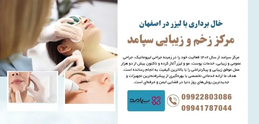 خال برداری با لیزر در اصفهان