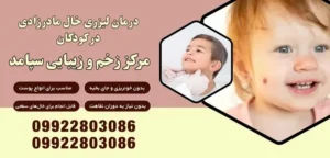 درمان لیزری خال مادرزادی در کودکان