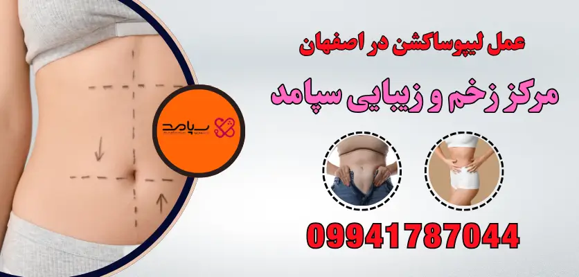 عمل لیپوساکشن در اصفهان