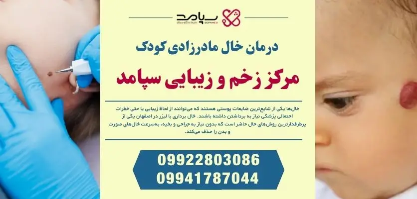 درمان خال مادرزادی کودک