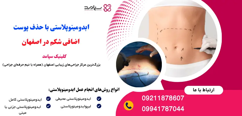 ابدومینوپلاستی با حذف پوست اضافی شکم در اصفهان