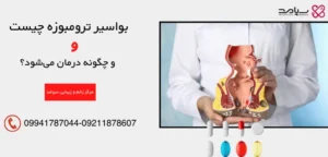 درمان بواسیر ترومبوزه