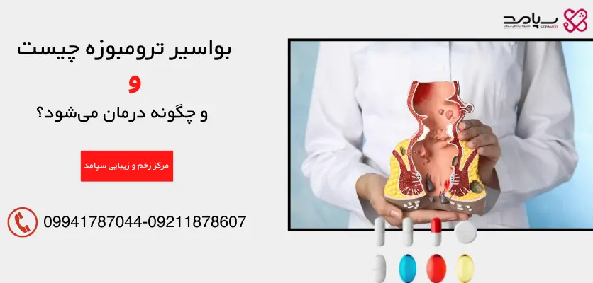درمان بواسیر ترومبوزه