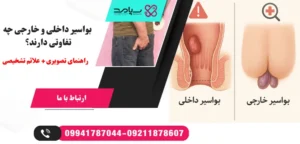درمان بواسیر خارجی و داخلی
