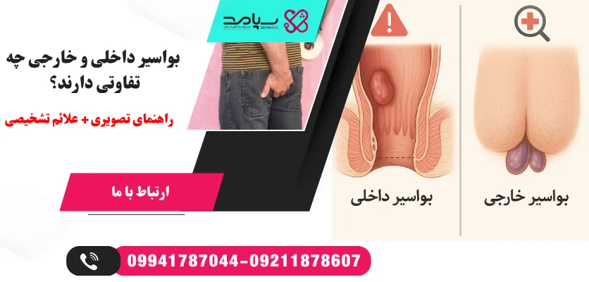 درمان بواسیر خارجی و داخلی