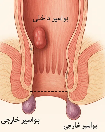 تفاوت بواسیر داخلی و خارجی
